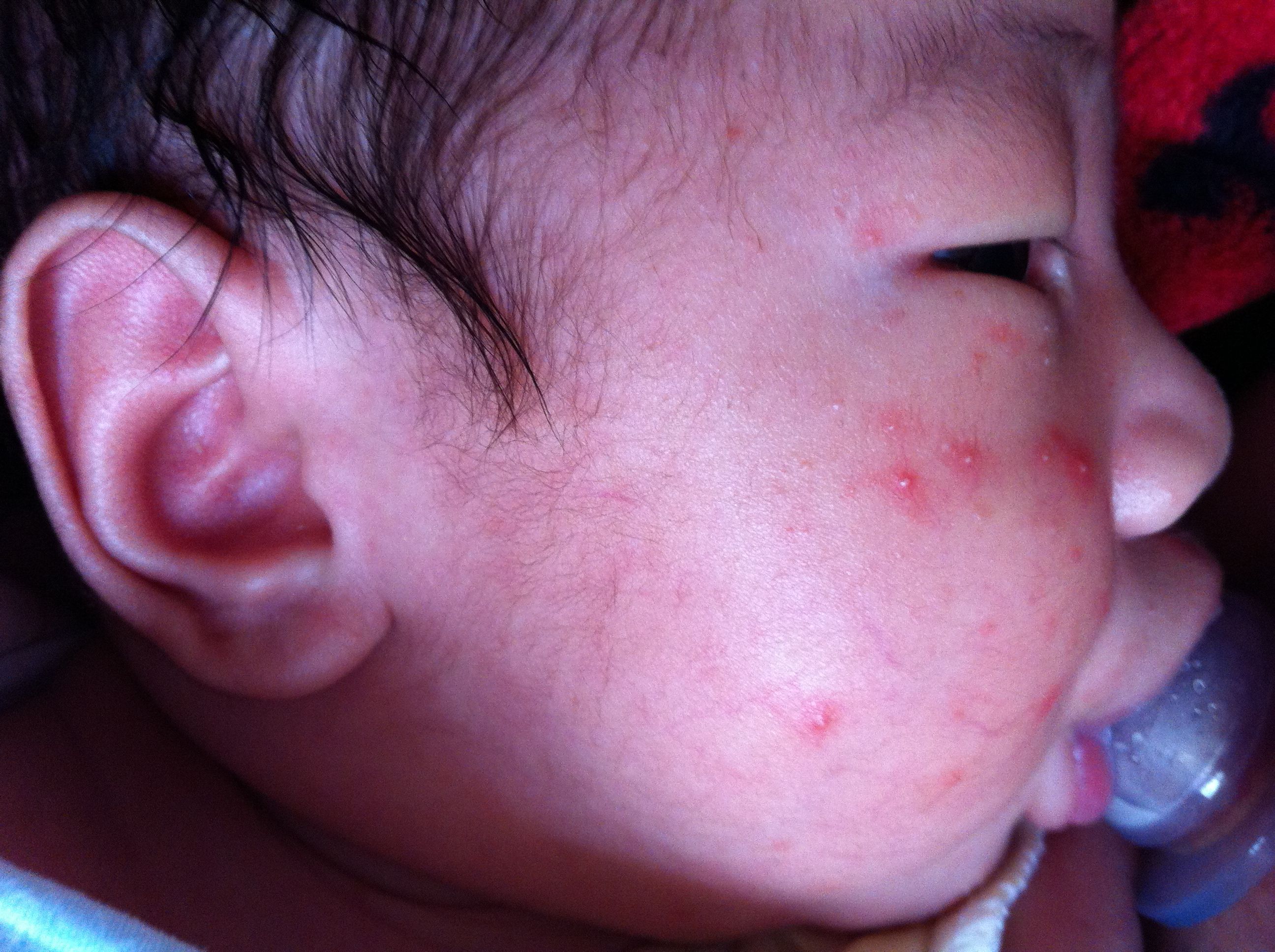 宝宝男孩儿出生25天了，身上起了小水泡，去儿童医院看了 说是水痘并发感染 这种并严重吗，有危险吗？急急 - 百度宝宝知道