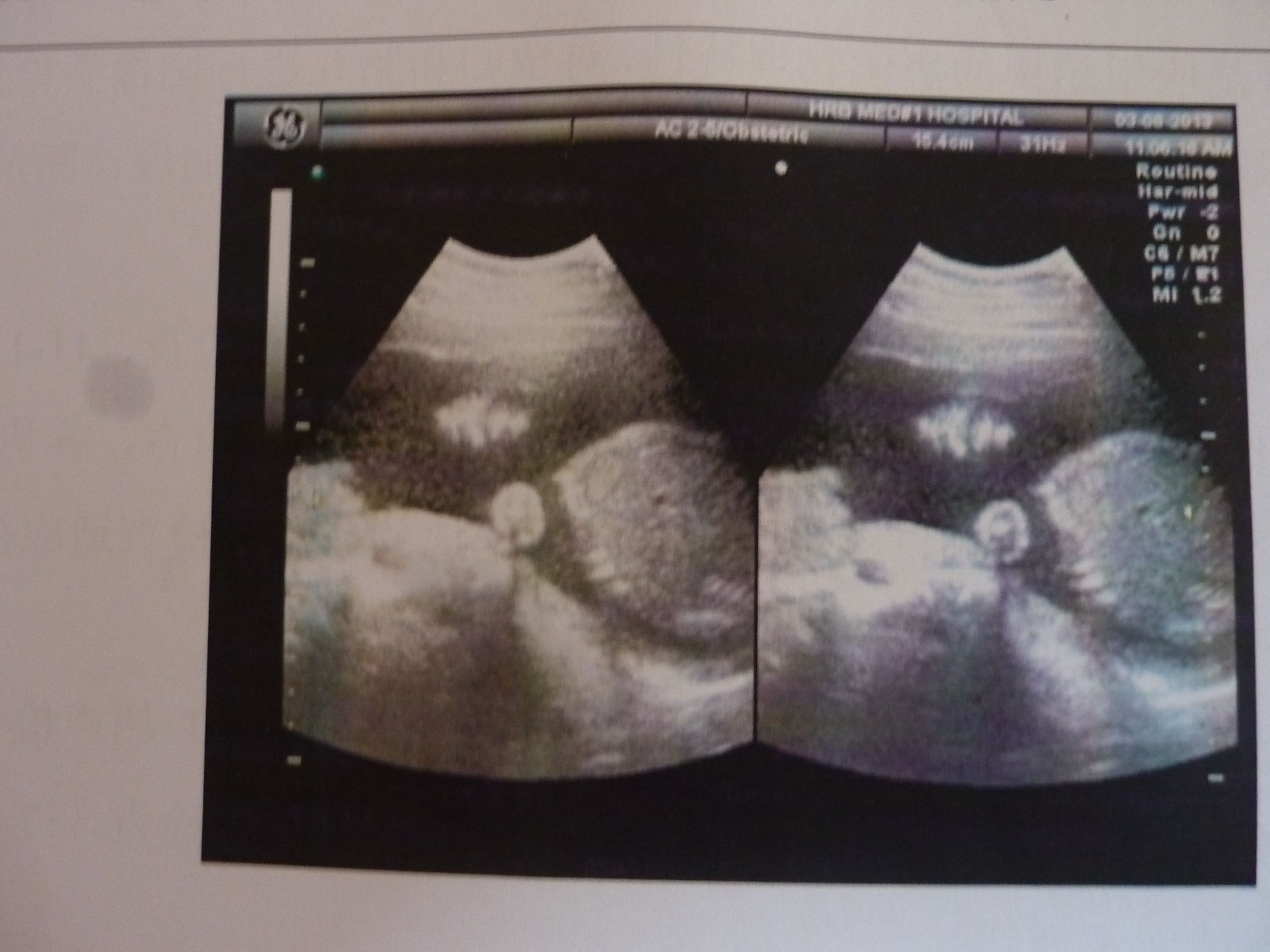 孕3月男女胎儿个性藏得深，摸清B超这几个数据，胎儿就没啥秘密了 - 百度宝宝知道