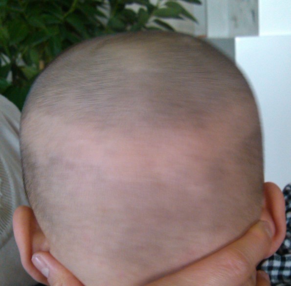 大家看下宝宝的头发是怎么回事?后脑勺一圈不长头发 上图