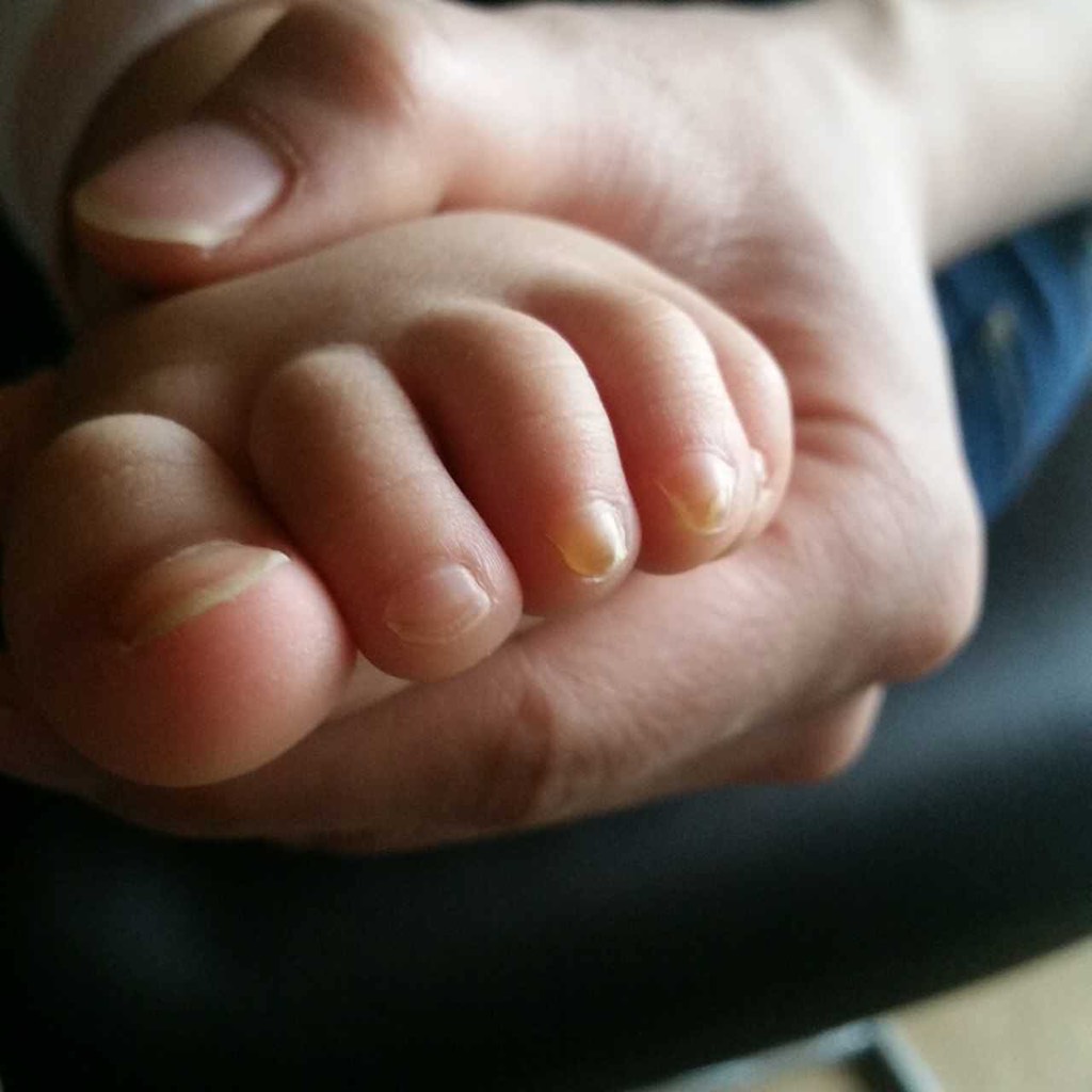 宝宝一岁七个多月了,从五六个月前左脚脚趾甲一个一个变黄变厚,现在