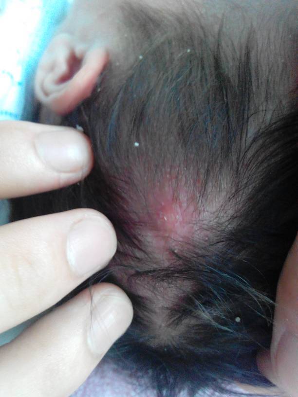 我家宝宝头上这个长得红色疙瘩是什么?-?有点硬!