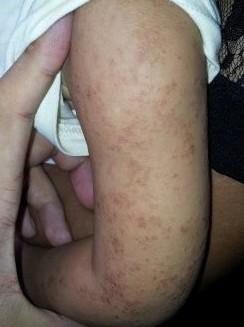主要症状等):男孩,1岁半,左臂上及左半身起满了 湿疹 (红豆豆)不痒,本
