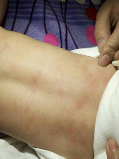 儿子八个月了 只有后背起了这样的红点点是什么情况