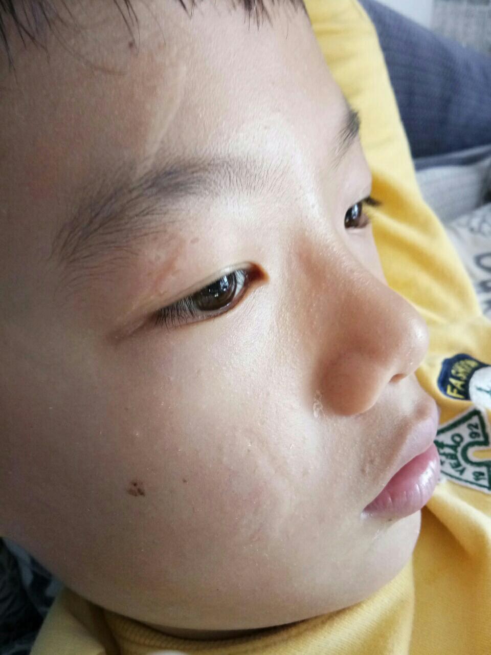 宝宝脸上缝的美容针好了以后会留下疤痕吗