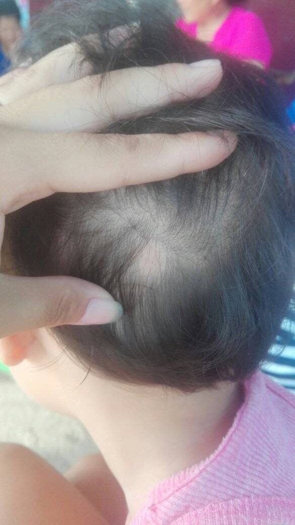 小孩头发斑秃初期图片图片
