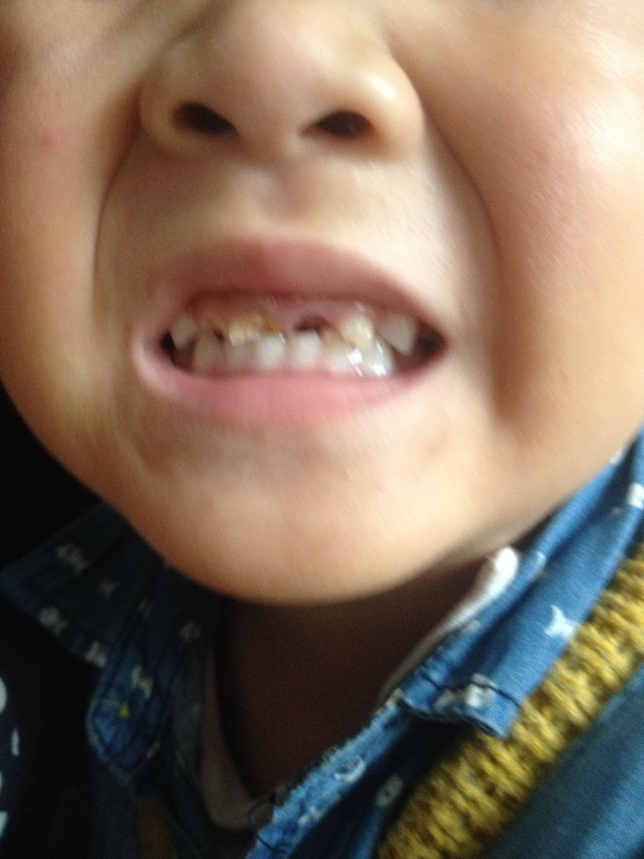 3岁半宝宝牙齿烂了,全是洞,怎么办啊