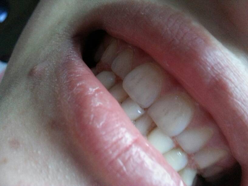 门牙裂纹图片