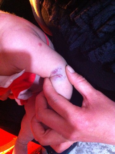 55天宝宝手臂上有1厘米深度的血管瘤那种治疗方法好?