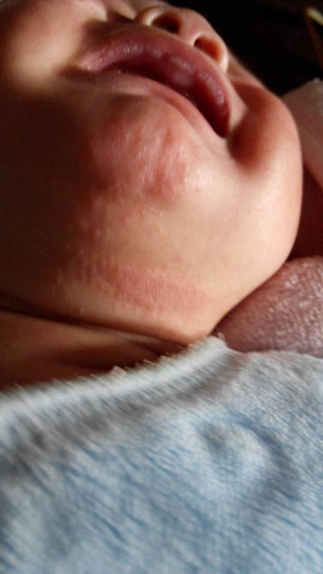 宝宝乳头湿疹图片