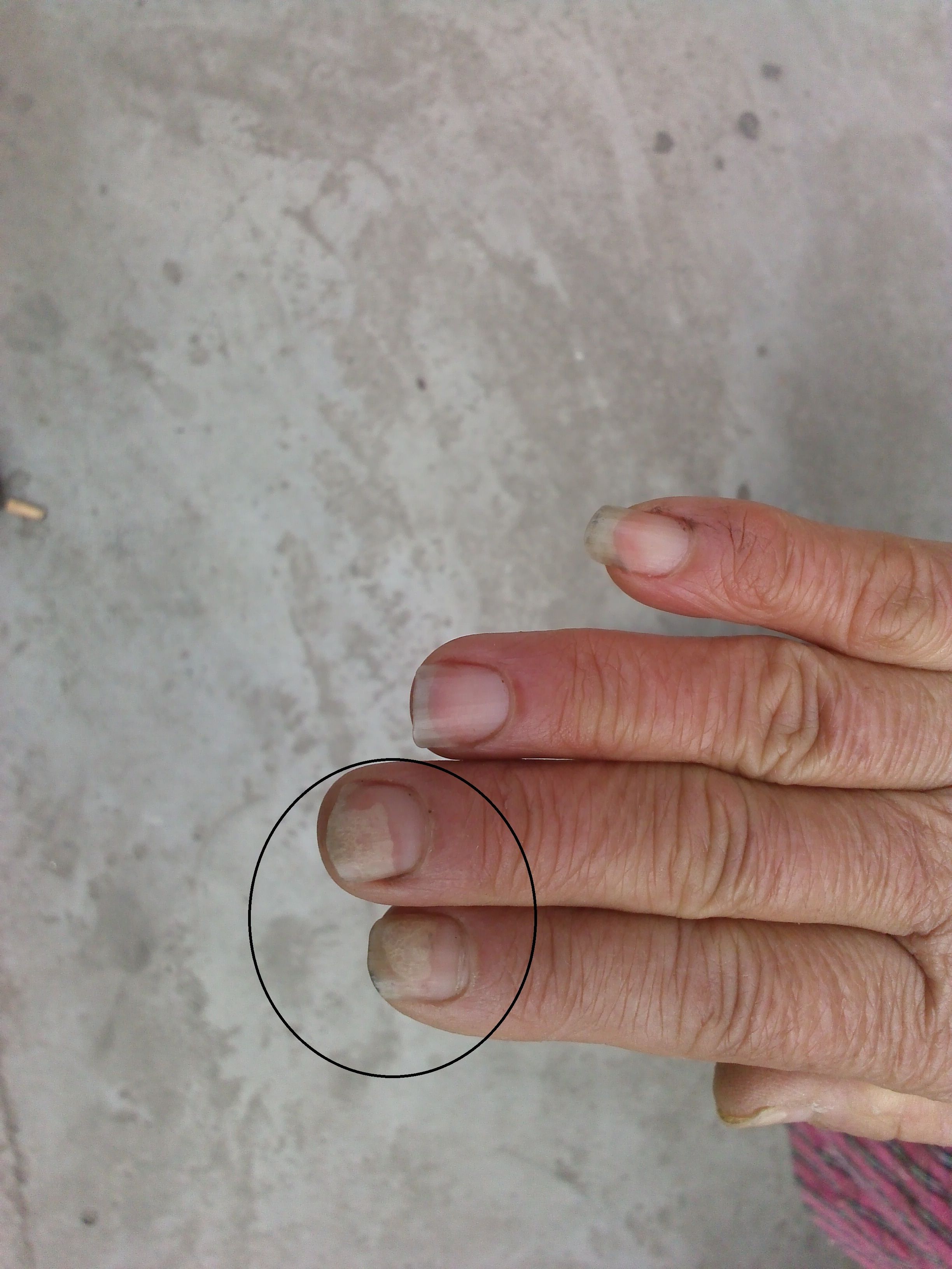 指甲蛔虫斑图片