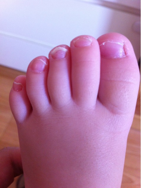 宝宝脚趾中指短图片图片