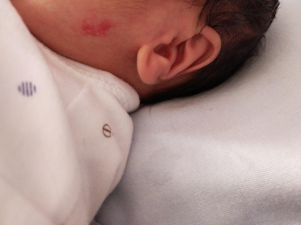 有没有宝宝脸上长红色胎记的?