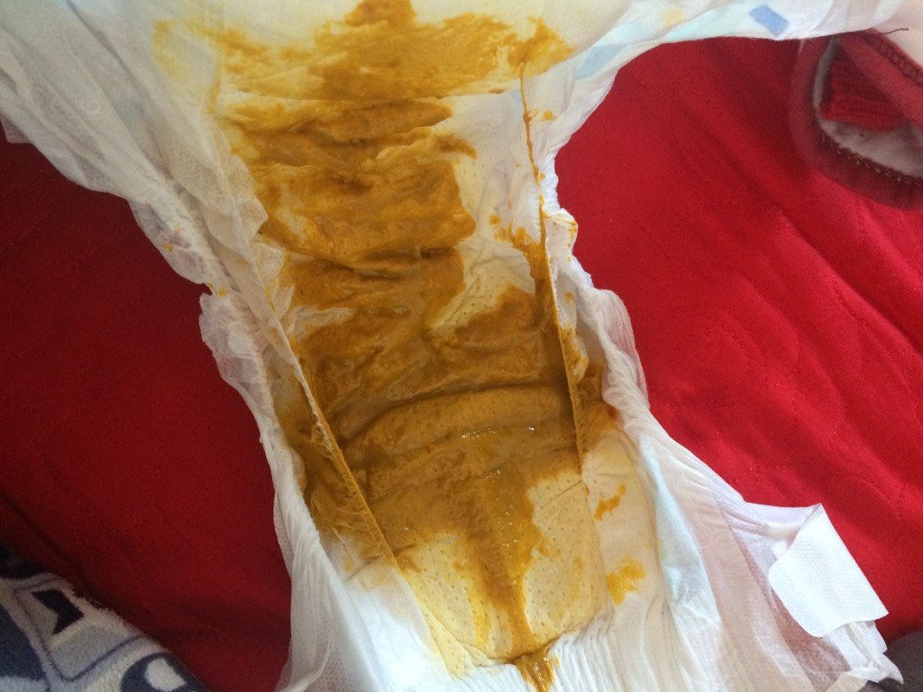 有图慎入 三个半月的母乳宝宝,这样的便便正常吗,一两天一次大便,和