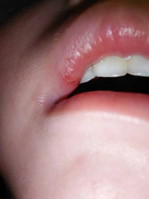 宝宝嘴唇烂了,怎么办