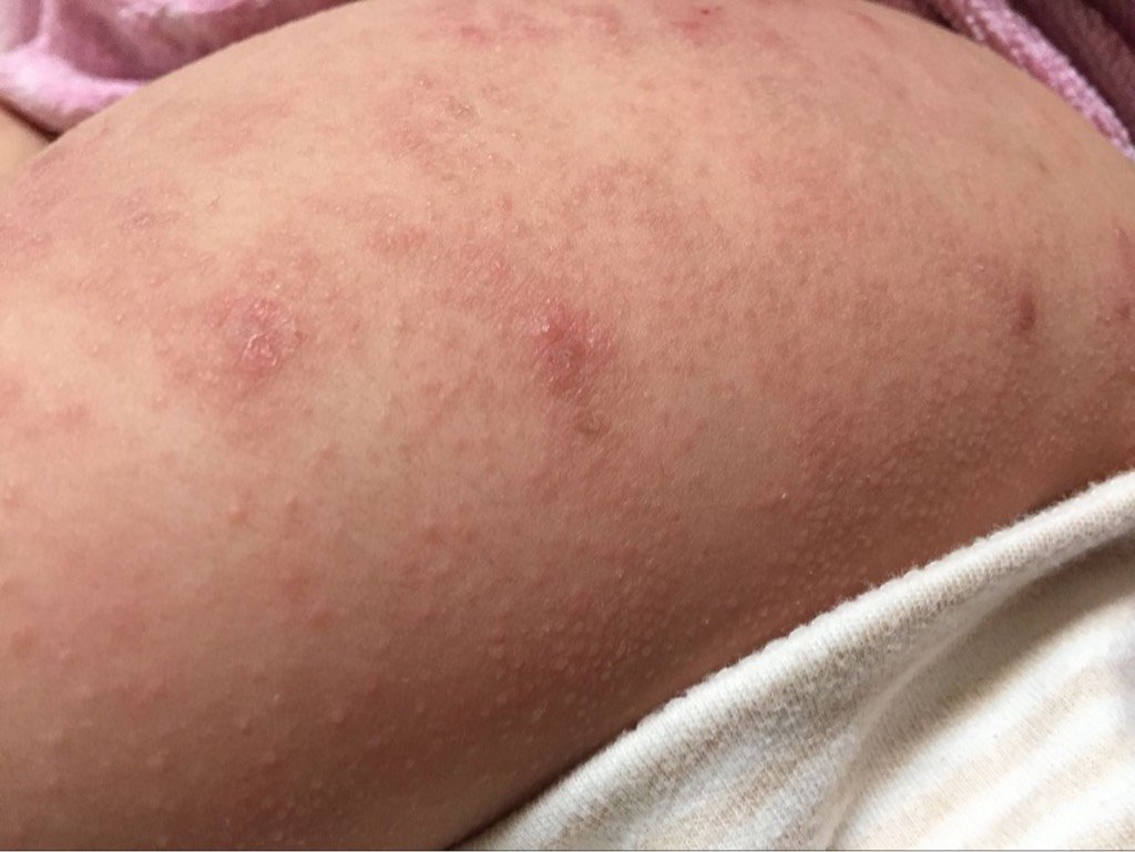 宝贝身上起东西 全身都是 跟癣一样 有没有医生帮我看看这是什么东西