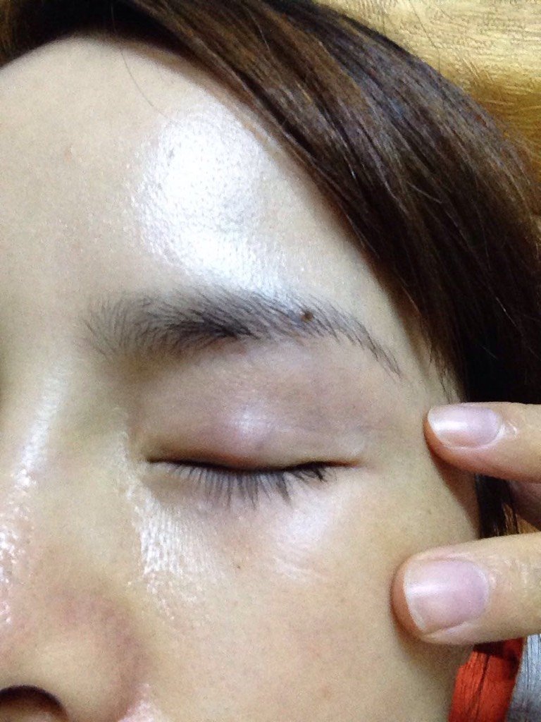 眼睛眼皮上长了一个像瘤子一样的东西,不痛不痒,没什么感觉.