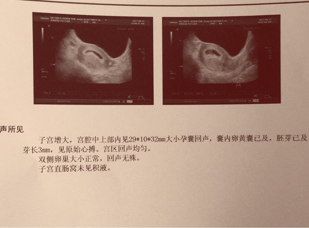 怀孕多久可以做b超看宫内宫外的