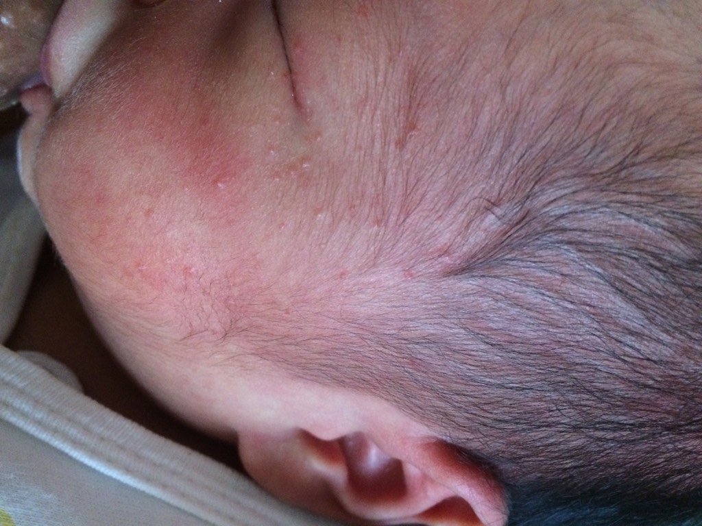 宝宝额头上长出一个红斑是什么？ - 百度宝宝知道
