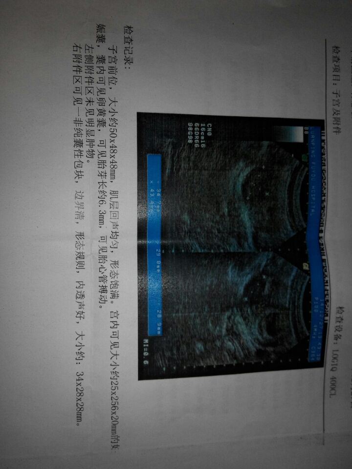 我老婆怀孕52天做b超出现结果其中的256mm是不是医师搞错了