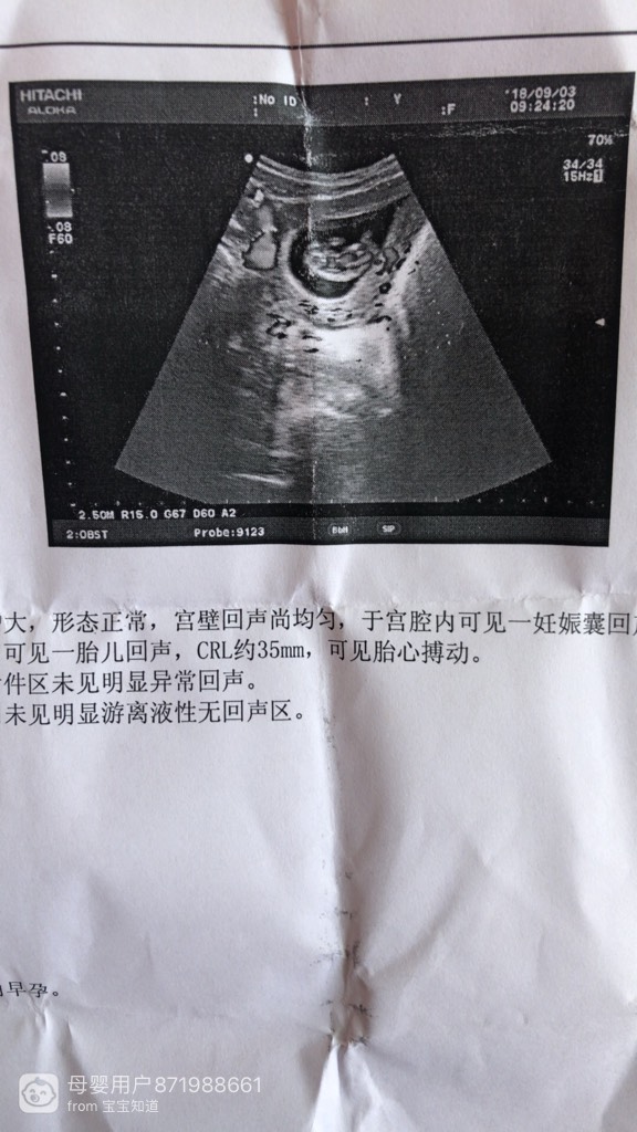 b超单子上crl约35mm是什么意思有多大了几个月了麻烦你们了