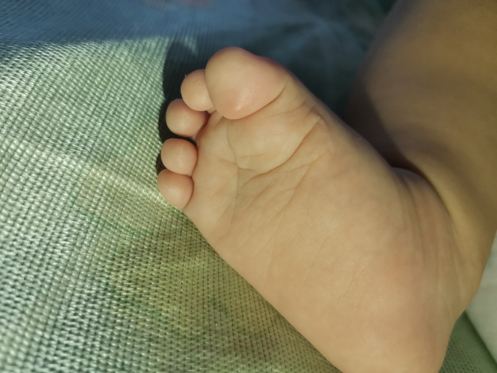 两个月宝宝大脚趾有个泡怎么回事