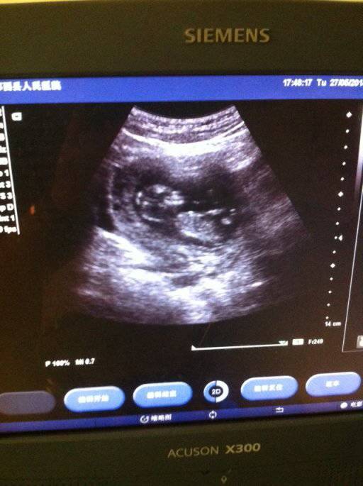 正常三个月胎儿彩超图图片