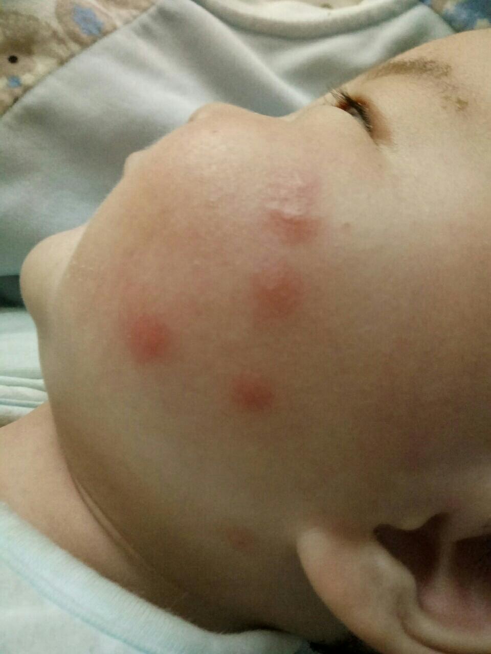 热 精 宝宝脸上长湿疹怎么办 宝宝脸上湿疹护理