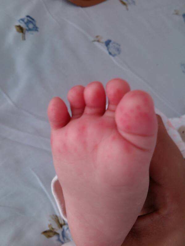 我家宝宝三个月大,之前右脚前脚掌起小红点,去医院查白细胞有些少,说