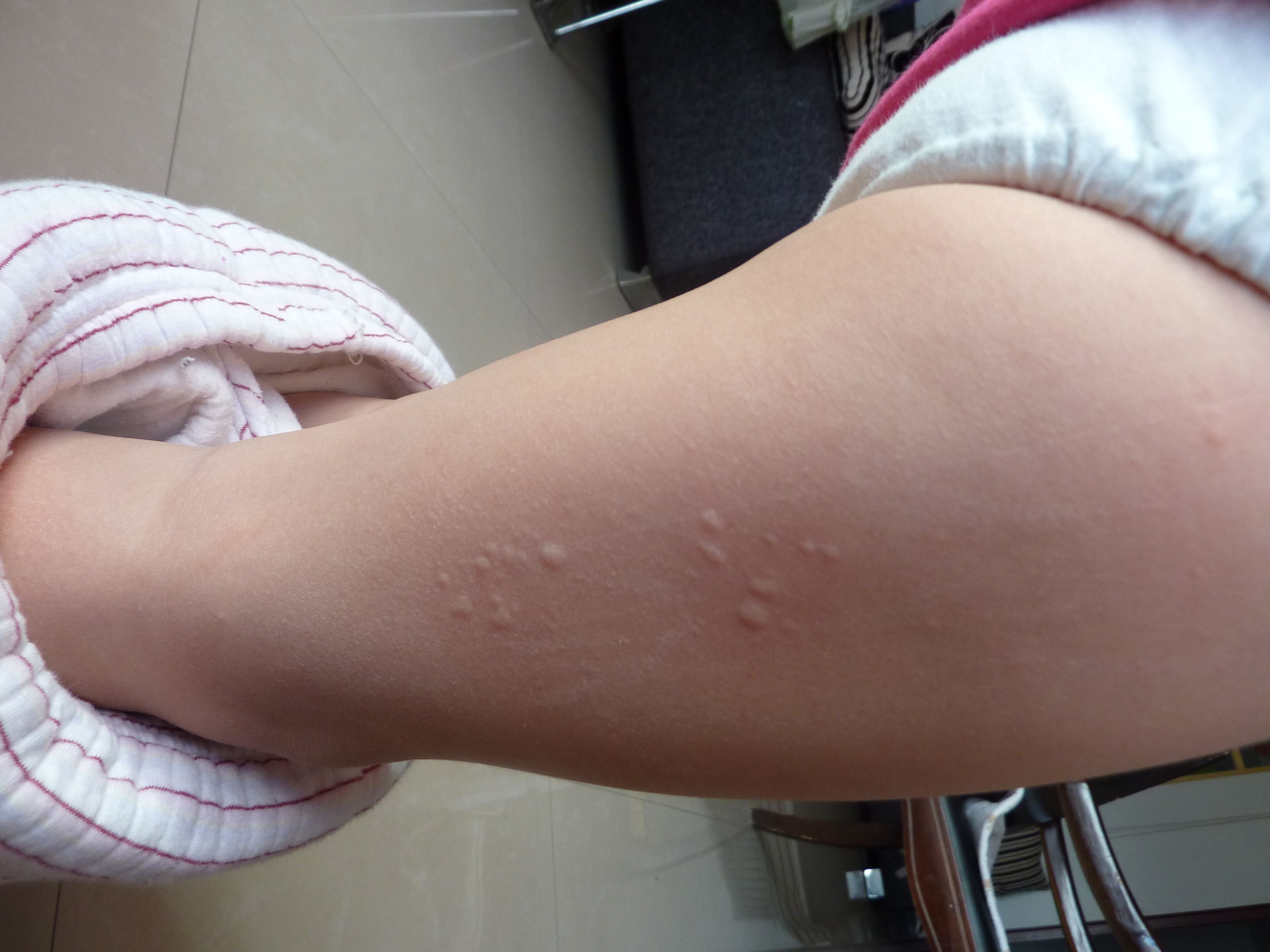 三岁宝宝身上老是出疙瘩,出来的快,下去的也快,还痒痒,这几经连续出了