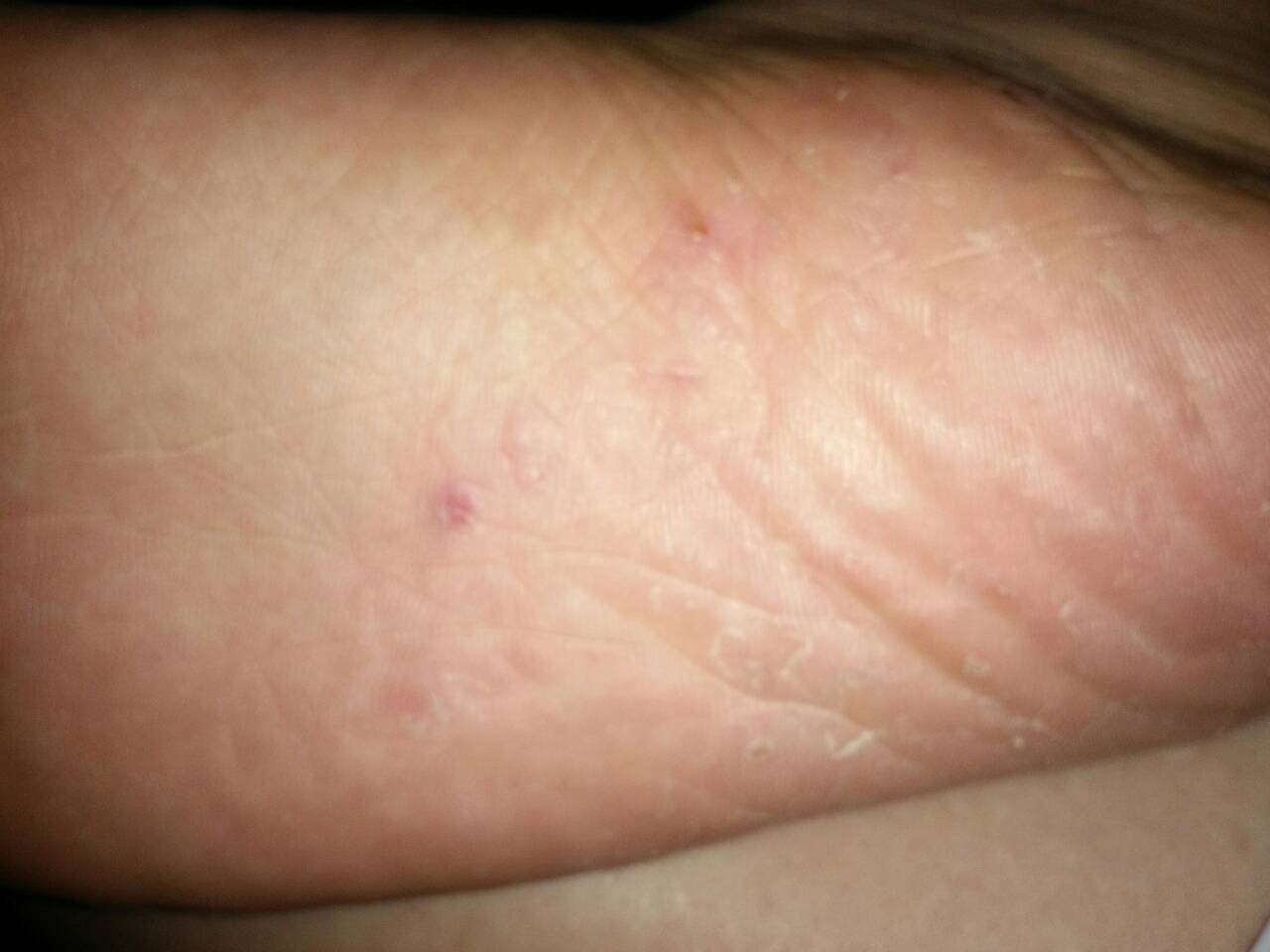 女孩子脚底脱皮,而且经常发痒是什么原因,怎么办?