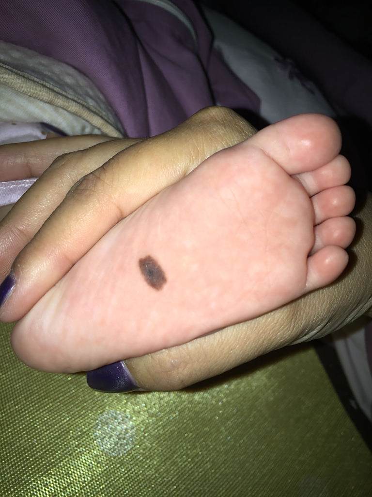 09-06 01:54     推荐回答 也许就是个胎记 ,  可能就是个普通的黑点