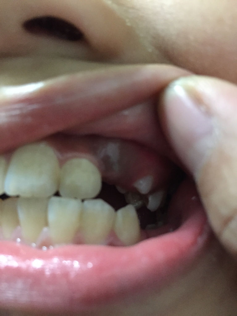 小孩掉牙处牙龈发青牙齿掉了大半年未长牙谢谢解答