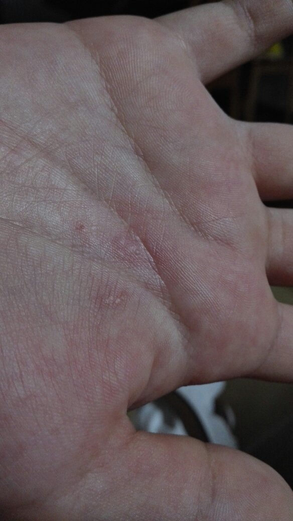 12岁小孩手掌起泡泡,会痒,不会疼,请教什么原因?谢谢!