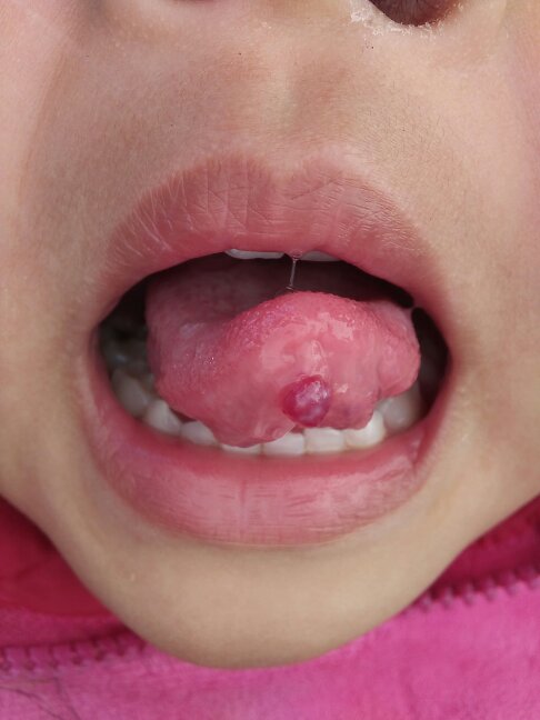 宝宝舌头上疱疹图片图片