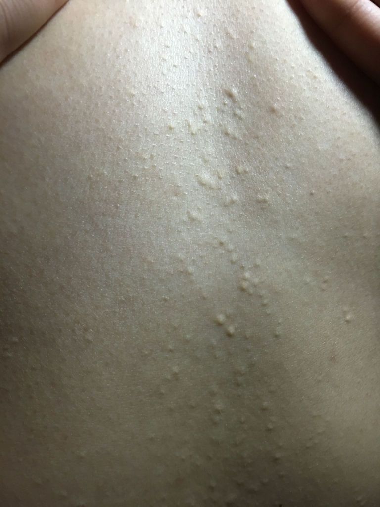 我是个女孩子 不知道胸前起了好多小痘痘 从胸前到肚脐眼一年多了不疼