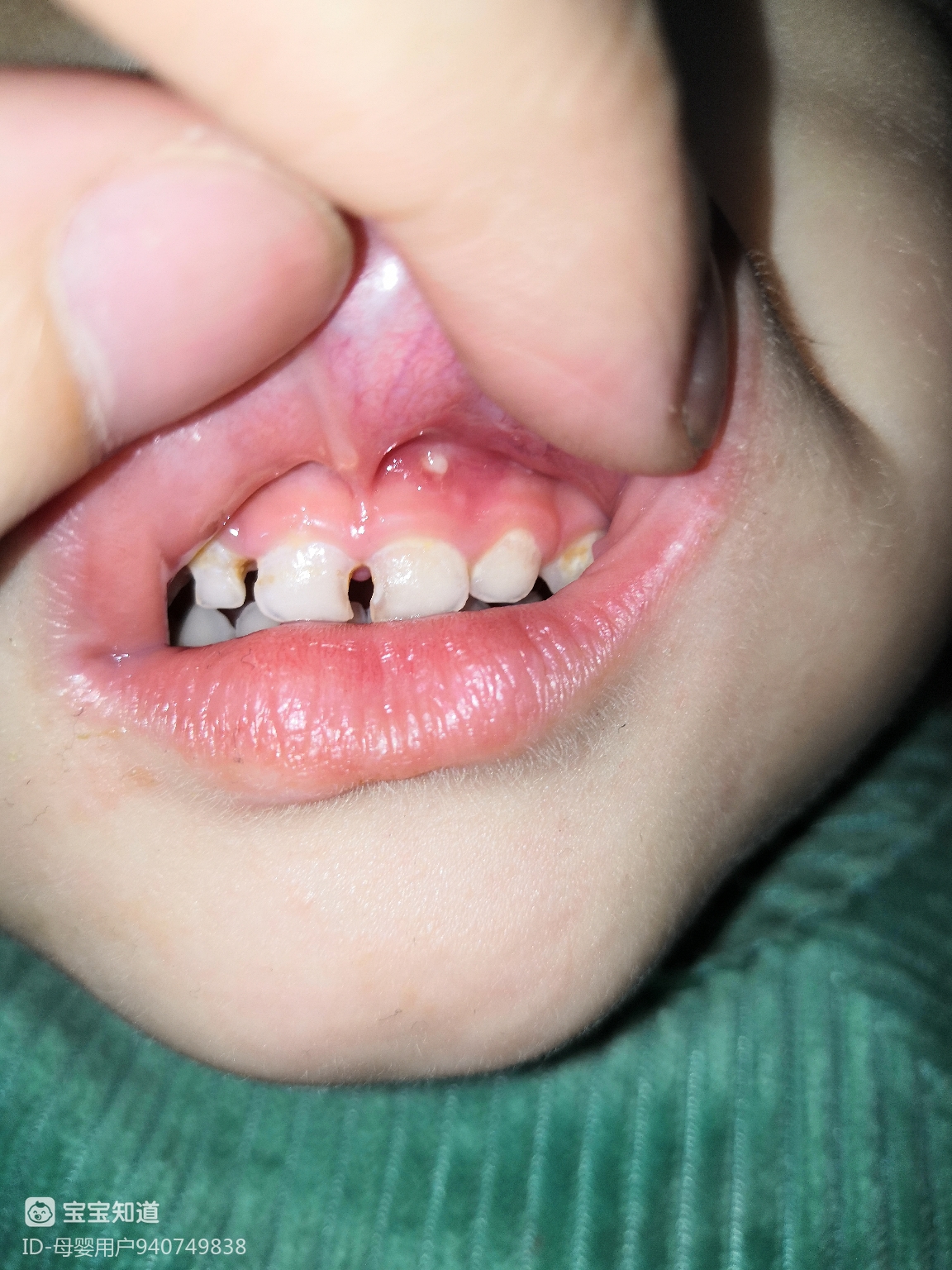 牙龈出现白色颗粒图片