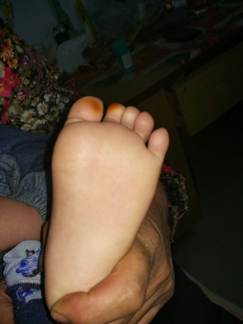 宝宝一周岁,右脚趾头有两个发红黄 不疼不痒求解答