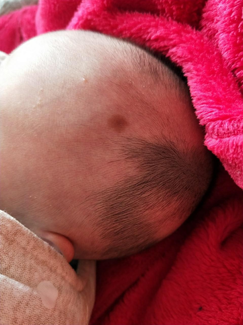 新生儿褐色胎记图片图片