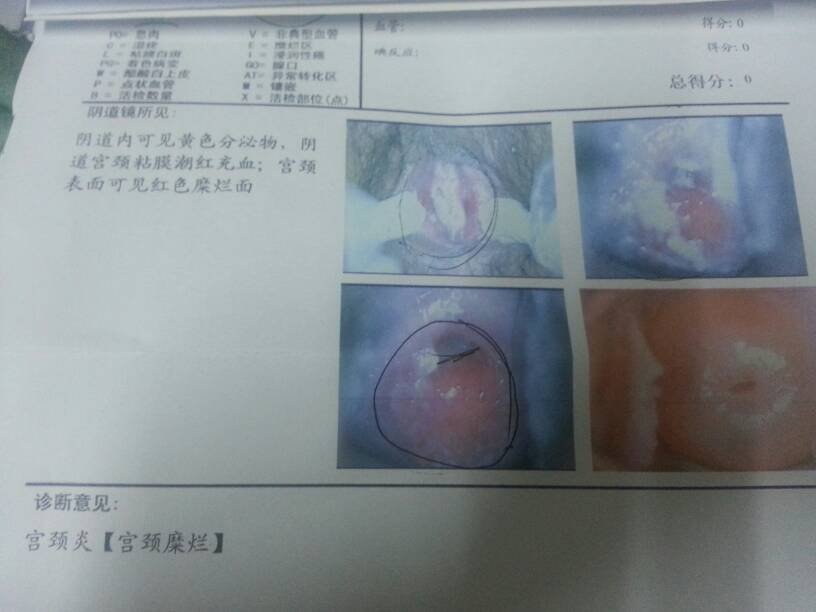 阴道内可见黄色分泌物,阴道宫颈粘膜潮红充血,宫颈表面可见红色糜烂面