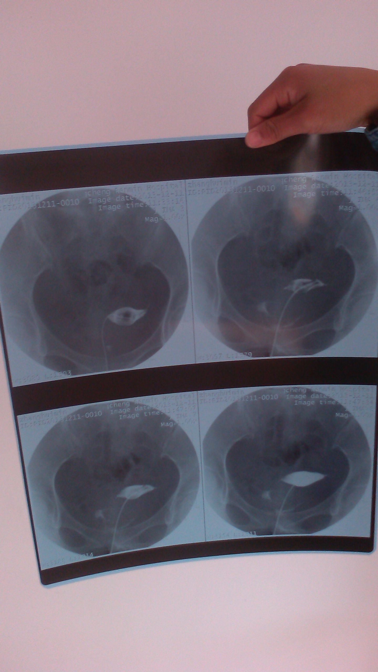 内壁光滑,整齐,大小正常,造影剂显示至双侧子宫角,输卵管辖部见少量