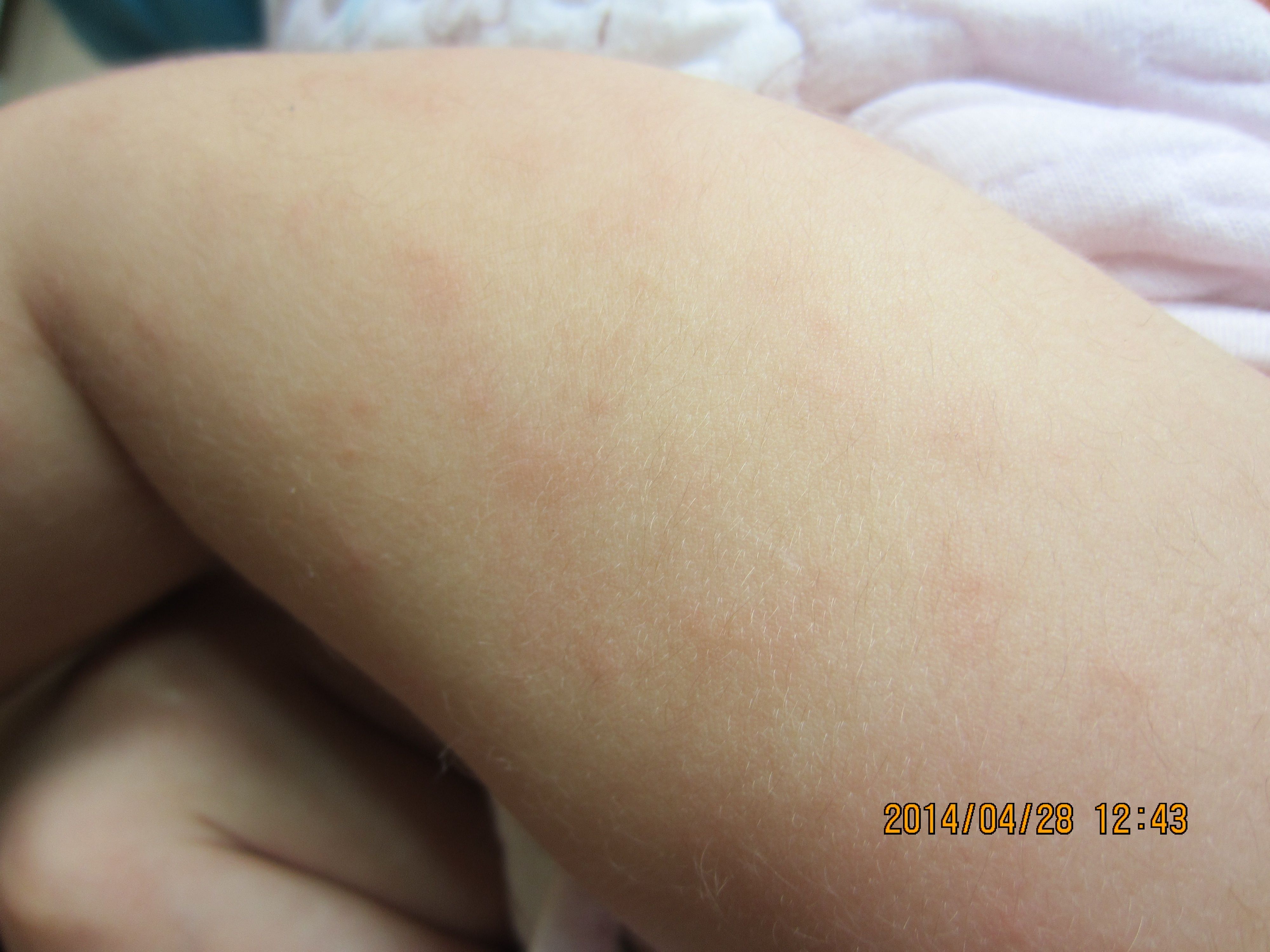 宝宝身上出了很多红包包,越来越多!