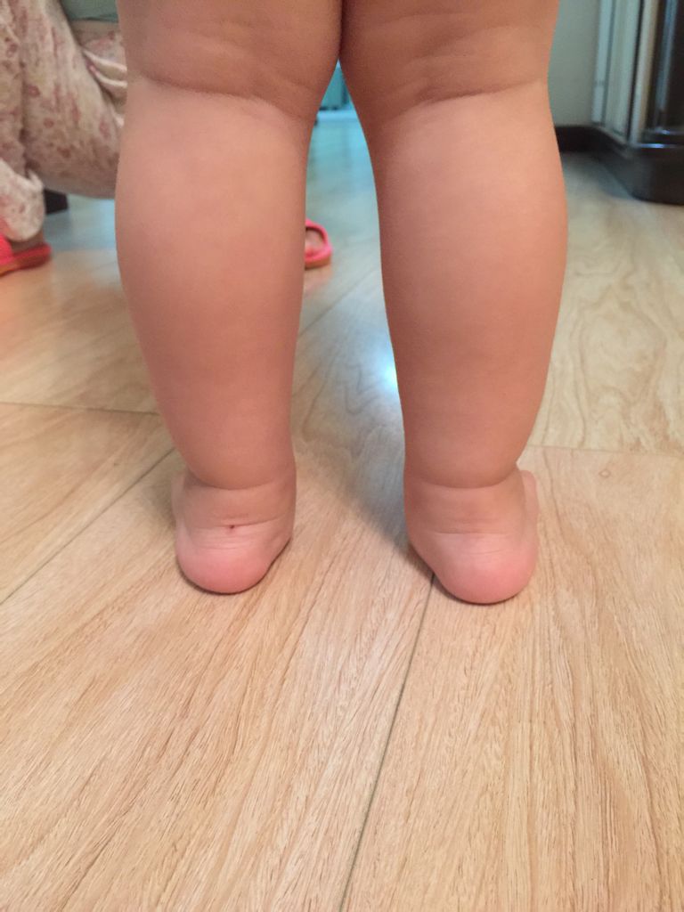 臀位宝宝的腿外翻图片图片