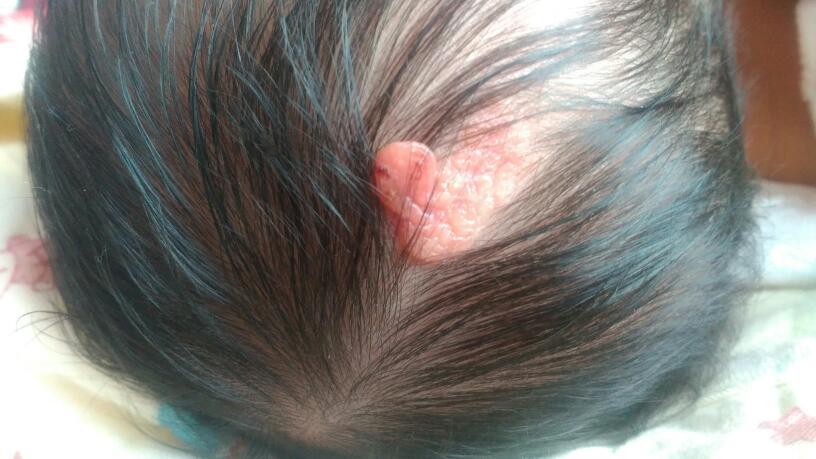 宝宝出生三天了,可是头上长了个软包,宝妈肚子有点粘连,缝的时候不好