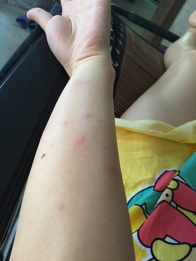 怀孕16周,昨天早上开始手臂好多好多像小蚊子咬的,又