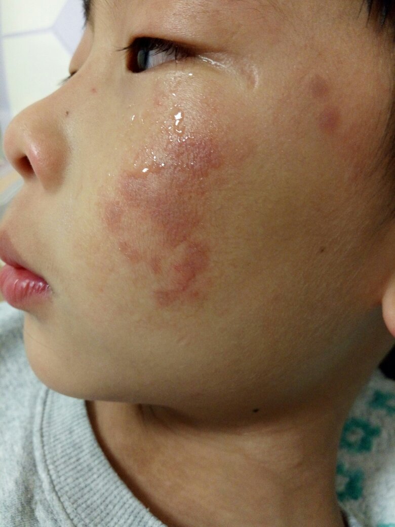 儿童花粉过敏症状图片图片