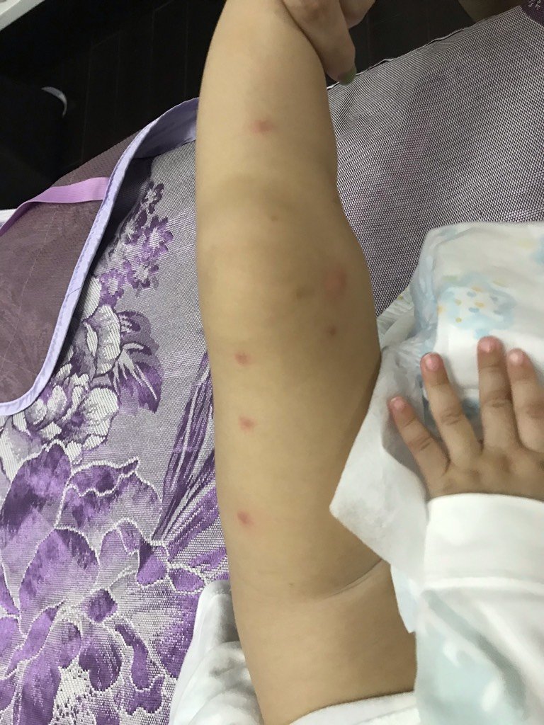 手足口病初期症状及图片