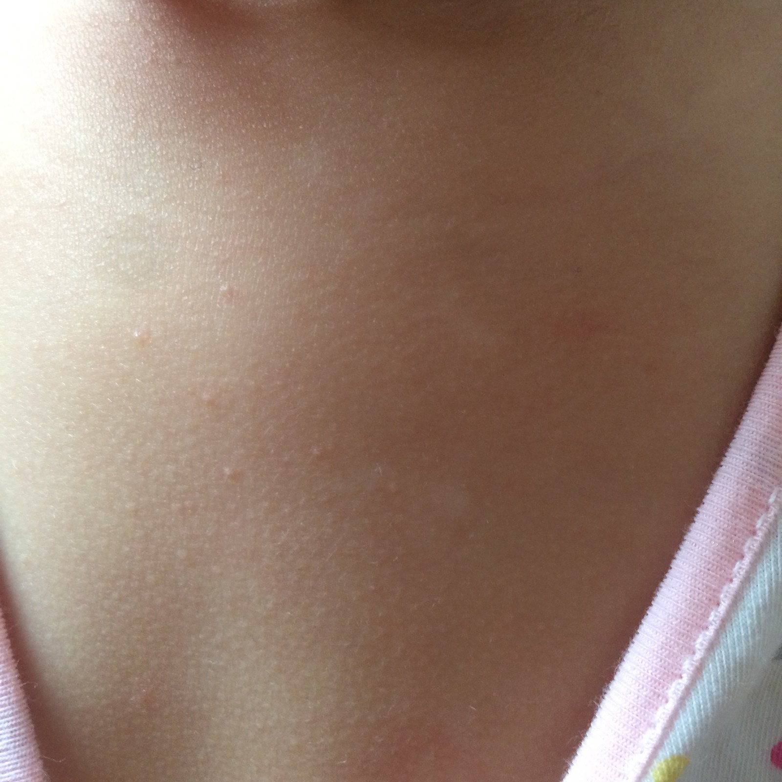 2岁半的女宝宝胸口有3个白斑?是白癜风吗?