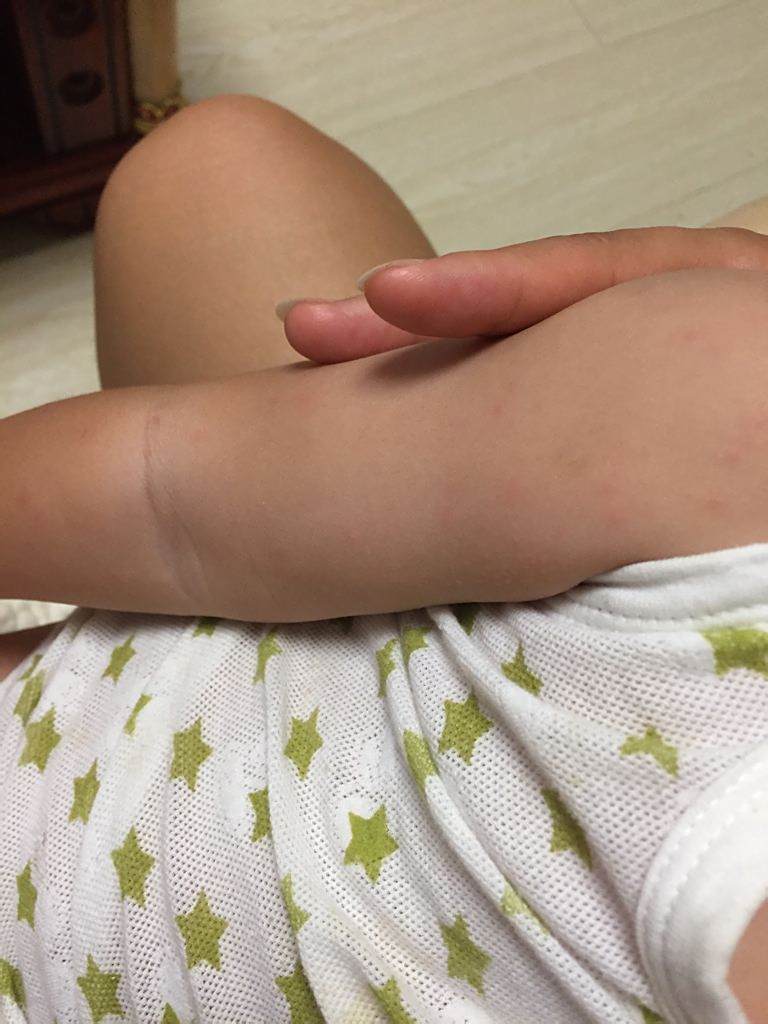 大家好,我儿子一周岁,注射青霉素慢性过敏,身上起了一些小红点,请问有