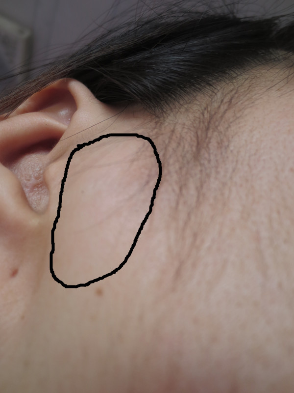 耳朵附近的淋巴位置图图片