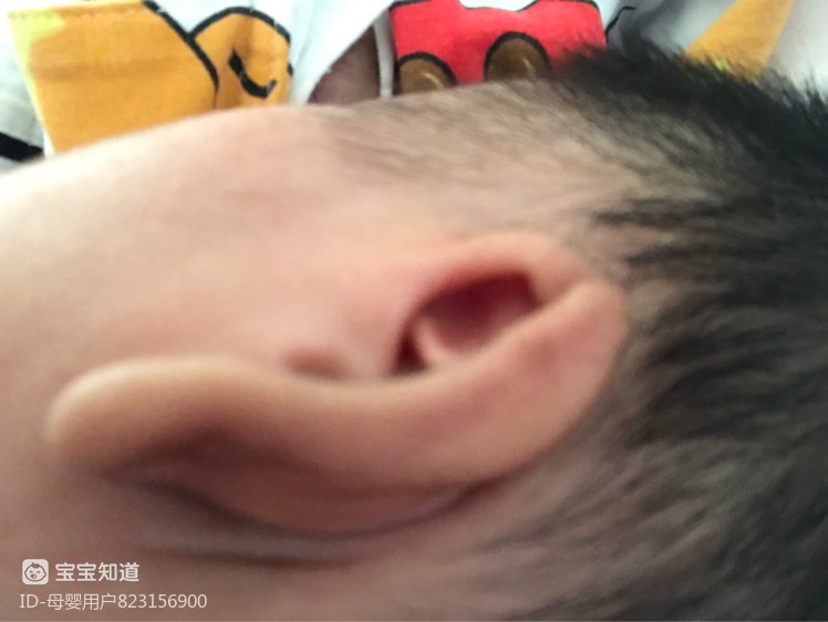 宝宝34天了,两只耳朵的耳廓都是粘连的很严重,就像长在一起了,听力测